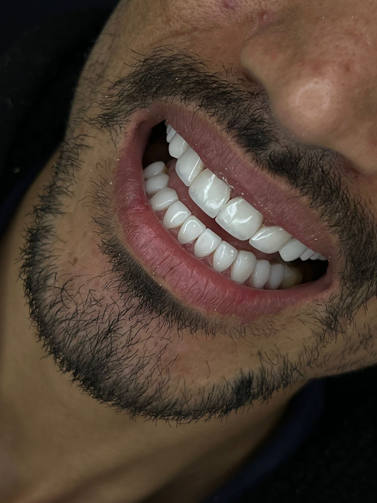 Depois